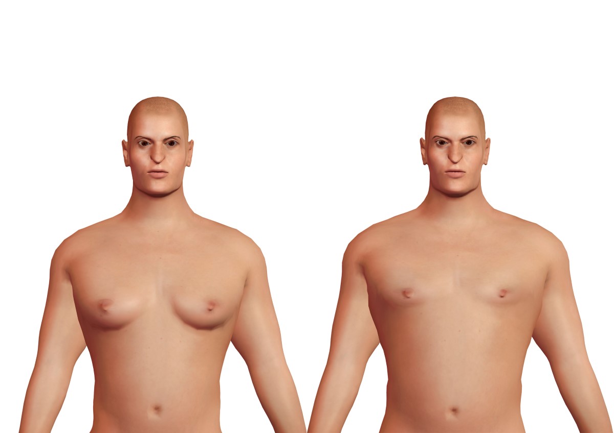 Ginecomastia masculina à esquerda e busto masculino fisiológico à direita. Fonte da foto: Getty Images Ginecomastia e seios fisiológicos nos homens